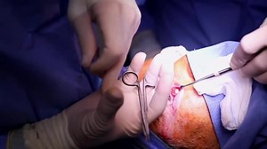 Eye Lift aka Lower Blepharoplasty (GRAPHIC)