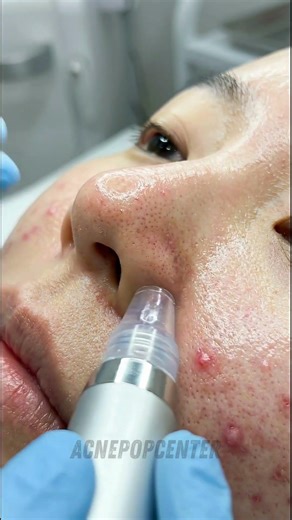 ASMR | Real Blackhead Extraction on Korean Nose with Nano Suction