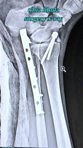 tibia fibula surgery x-ray #xraytechnicians #sdradiology #tibia #fibulafracture #feacbook #trendin