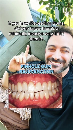 Pinhole Gum Rejuvenation for Receding Gums