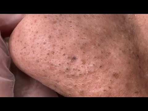 Deep Facial Cleansing - Best Remedies & Techniques For Acne & Blackheads!