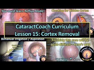 CataractCoach™1721: curriculum lesson 15: cortex removal