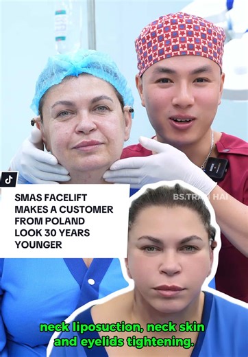 Transformative SMAS Facelift Experience in Poland