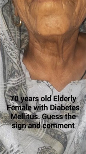 Clinical Signs | Bedside Medicine | Elderly Diabetic Female #mrcp #paces #fcps #medicine #medical