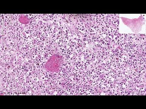 Osteomyelitis - Histopathology