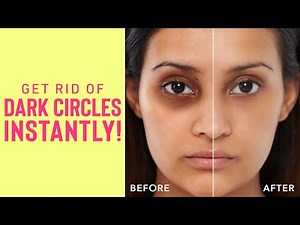 Dark Circle Remedies That Actually Work | Instant Dark Circle Cures!!
