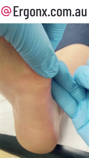 Unbelievable Callus Removal with Scalpel Amazing Podiatry Results #Podiatry #CallusCare