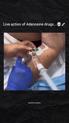 Medical explainer on Instagram: "The immediate action of intravenously injected adenosine is extremely rapid and short-lived, primarily targeting the Atrioventricular (AV) node in the heart. ⚡ Immediate Action: AV Nodal Blockade/Slowing: Adenosine binds to A_1 receptors in the AV node, which leads to: Slowing of conduction time through the AV node. Interruption of re-entry pathways that rely on the AV node. This effect can momentarily cause a short-lasting heart block (first, second, or third de