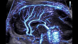Try this week’s #ISUOGEducation challenge! Case study: fetus referred at 22 weeks of gestation for a difficult visualisation of the cavum septum pellucidum. At a sagittal view of the fetal brain, the corpus callosum measured 17.3 mm. Is there an association with genetic disorders? a. Normal length of corpus callosum. No risk of genetic anomalies b. Partial agenesis of the corpus callosum with absent rostrum. Association with single gene disorders in about 30-40% of cases c. Hypoplastic corpus ca