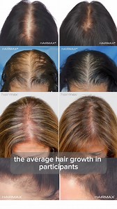 17K views · 11 reactions | Is thinning hair getting you down? We have...