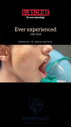 What Is Jaw Lock? 😬 #youtubeshorts #medicalshorts #healthshorts