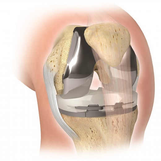 Total Knee Replacement Specialists in Indiana