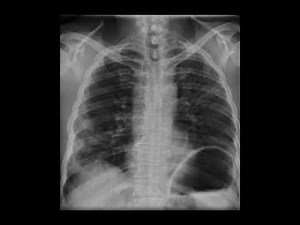 Diaphragmatic Hernia in Adults: Clinical Case, Causes, Symptoms, and Treatment