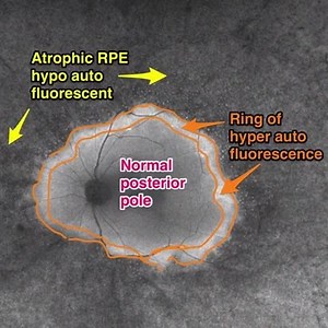 Retinitis pigmentosa, autofluorescence imaging findings: the ring of hyperautofluorescence denotes the area of retina that will die next as the disease advances posteriorly. It's important to note the absence of pigment migration "bone spicules". Despite giving the name to the disease these are not critical for the diagnosis. More important clinically is the thinning of the retinal vessels and thw faint loss of normal pigmentation peripherally. The optic pallor may also be a late clinical findin