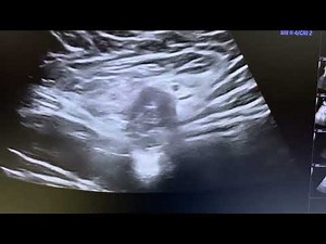 Ultrasound of direct inguinal hernia