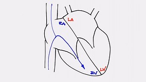 Atrial septal defect is a congenital heart condition in which a hole in the wall of the heart separates the top two chambers and allows blood to transition from the left atrium to the right atrium ultimately causing enlargement of the right heart chambers. Find out more about how this condition can affect adults later in life. https://mayocl.in/2XrbD8J | Mayo Clinic