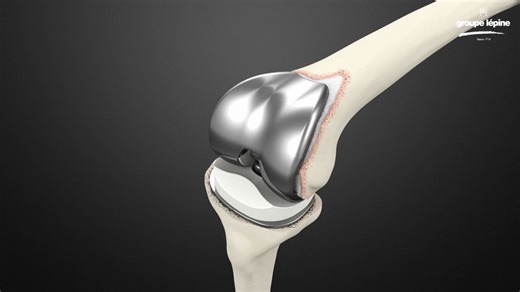 铰链膝关节——HINGE KNEE PROSTHESIS ROTAX™ Surgical Technique