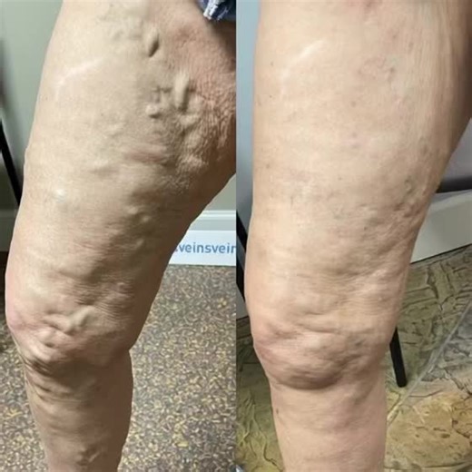 Hratch L Karamanoukian MD FACS on Instagram: "Microphlebectomy or Sclerotherapy for Varicose Veins ? The decision to use one technique or the other or both depends on the size of the veins and on examination and venous ultrasound imaging as well as vein mapping. This is done at consultation by Dr Karamanoukian. We accept Blue Cross Blue Shield, Federal Blue Cross, Highmark, Univera, United Healthcare, Aetna and Medicare. Medicare Advantage plans follow Medicare guidelines for treating varicose v