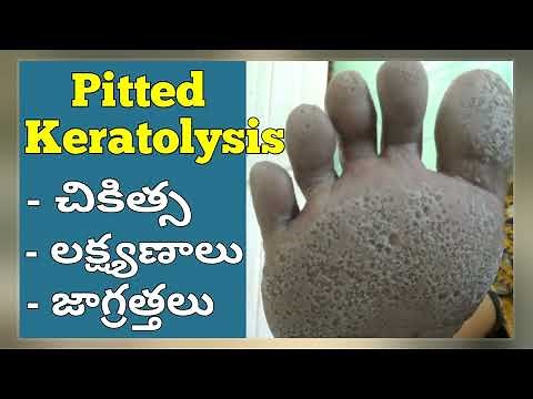Pitted Keratolysis