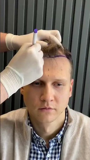 Hair Transplant Turkey Before and After #hairtransplantturkey #hairtransplant