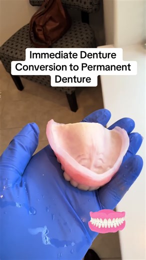 Immediate Denture Conversion to Permanent Solution