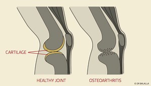 Arthritis & Knee Replacement