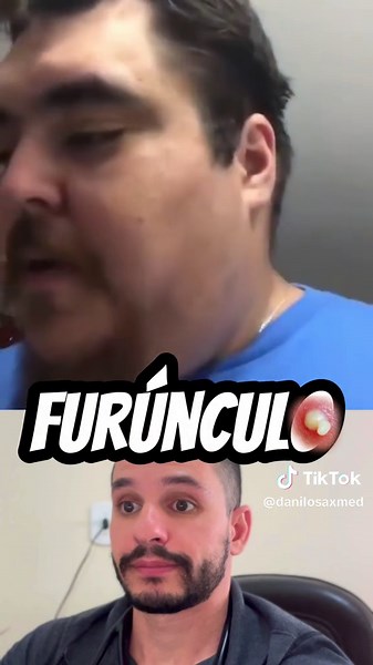 Furúnculo: Causas, Sintomas e Tratamento Eficaz