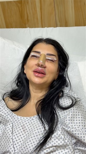 𝓓𝓻. 𝓗𝓪𝓴𝓲𝓶 𝓶𝓪𝓴𝓴𝓮 on Instagram: "2 hours after 3 operations ( Rhinopalsty with lips lift and blepharoplasty) Happy patient 🥰 beautiful natural result 🤩 No pain , little bit swollen 🌎Beirut , Nabatieh : Lebanon 🇱🇧 📞+961 71 08 08 80"
