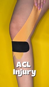 121K views · 970 reactions | ACL INJURY #kinetape #kinesiotape #tape #kneepain | Kinetape Academy | Facebook