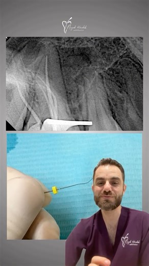 Dr. Najeeb Hmedosh | Endodontist on Instagram: "𝖳𝗈𝗈𝗍𝗁 #𝟥 • 𝐃𝐢𝐚𝐠𝐧𝐨𝐬𝐢𝐬: 12 years old patient, Deep caring into pulp, poor prognosis. • 𝐎𝐛𝐭𝐮𝐫𝐚𝐭𝐢𝐨𝐧: Single cone with Bio Ceramic Sealer. • 𝐋𝐚𝐬𝐞𝐫: Softtissne Reconturing. • 𝐑𝐞𝐬𝐭𝐨𝐫𝐚𝐭𝐢𝐨𝐧: Two fiber post with core build up. #endodontics #dentist"