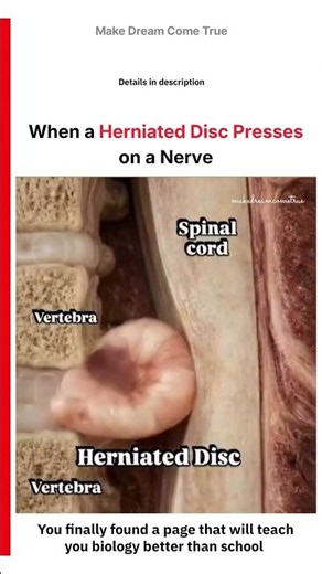 🦴 When a Herniated Disc ⚡ Presses on a Nerve 🧑🏻‍⚕️ | MDCT