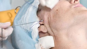 Modern beauty concept. Senior woman getting face thread lifting procedure. Close up. Doctor in surgery makes painful procedure to eliminate signs of aging. Beauty of Face, Facial contour, plastic