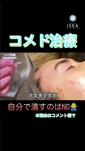 ニキビの毛穴詰まりや膿を取り除くコメド圧出の治療動画です。医療機関では専門器具を使用するためリスクを最小限に抑える事ができます。#イセアクリニック #大山希里子#ニキビ治療#毛穴ケア