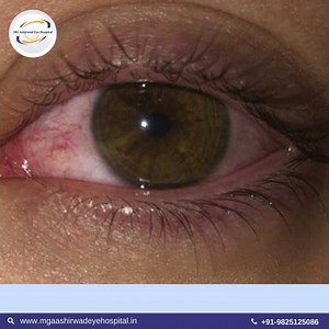 Corneal neovascularization occurs | Mahesh Garg | MG Ashirwad Eye Hospital