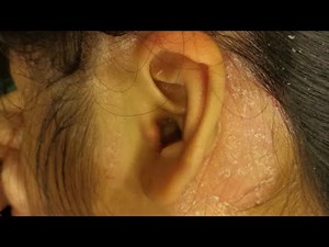 Stubborn Flakes and Psoriasis behind my Ear