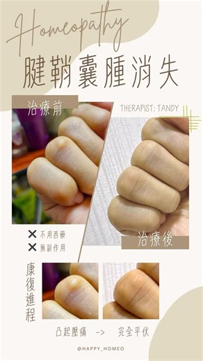 醫學個案💠腱鞘囊腫消失💠 只要用對方法，不用手術也能消失的㊙️ 「腱鞘囊腫」是關節囊或肌腱腱鞘的結締組織，由於久經磨損而出現退變，積聚的關節液或滑膜液所形成，常見於手腕、手指、足部或足踝附近。 腱鞘囊腫會影響腱鞘內的肌腱活動，令手指伸展困難，出現像扳指（彈弓指）的症狀。 ⚠️切忌擠壓組織，免得弄巧成拙！ 🩹對於順勢醫學來說，無論不尋常的組織退化，需要了解體質獨特性，找出體質療劑，再配合營養治療，改善關節退化積液問題，身體便能自然康復，不藥而癒。 🔆不用西藥不壓抑 🔆健康諮詢免診金 🔔pm治療師預約 📍太子診症中心 #happy_homeo #MyHomeoLife #Homeopathic #healing #homeopathyhk #順勢療法 #西方醫學 #200年歷史 #營養治療 #古典花療 #個人化體質處理 #體質治療 #我的新心活 #彈弓指 #腱鞘囊腫 #肌腱 #囊腫 #關節囊 #純素適用 #關節勞損 #磨損 | 我的新心活