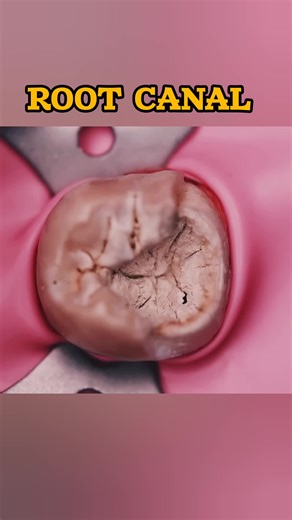 Insurance Disparities in Tooth Extractions vs. Root Canals