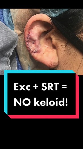 Using SRT to treat a keloid after excision has been a game changer. I enjoy doing these now, bc the keloid doesn’t come back! #drpimplepopper #SRT