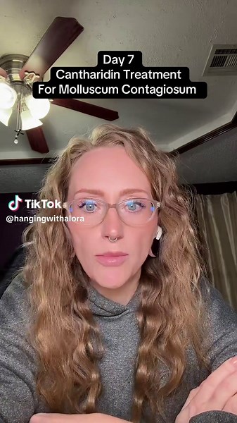 Cantharidin Treatment for Molluscum Contagiosum – Day 7