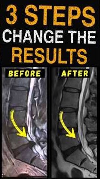 How to recover from Lumbar Disc Extrusion. 3 steps to follow #extrusión