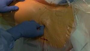 Revision Hip Arthroscopy for FAI & Labral Repair | Landmarks and Portal Placement (2/5)
