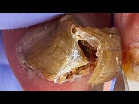 Black Toenails, Covered With Fungus! Completely Eliminate【Xue Yidao】