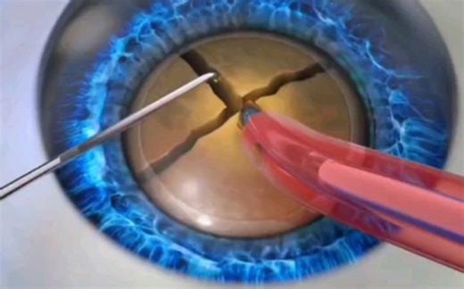 眼睛白内障手术过程，3D演示。。