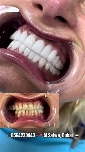 ✨ Smile Transformation with Dental Veneers ✨ From dull to dazzling! This amazing veneers transformation gives you a brighter, more confident smile in just a few visits. 😁🦷 ✔ Natural-looking results ✔ Corrects stains, gaps & uneven teeth ✔ Long-lasting smile makeover Ready for your dream smile? 💎 📩 Message us today to book your consultation! 📲 056 423 3443 📍 Al Satwa, Dubai 🇦🇪 #SkinAndSmileDentalClinic #SmileTransformation #DentalVeneers #DubaiDentist #perfectsmile
