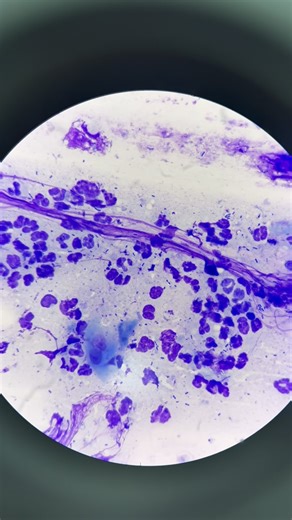Mustafa Elsobky on Instagram: "NETosis : refers to the release of Neutrophil Extracellular Traps (NETs), characterized by: 1. *DNA release*: Neutrophils release chromatin. 2. *Web-like structures*: Trapping pathogens. *Otitis Externa* Signalment : Flex 🐈 DSH Male Adult 6 yo Sample : Ear Swab Test : Ear swab Cytology 🔬 Report : .Degenerate Neutrophils .Bacilli & Cocci Bacteria .Phagocytosis .Epithelial Cells .Septic Neutrophilic inflammation"