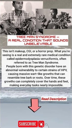 TREE MAN SYNDROME — A REAL CONDITION THAT SOUNDS UNBELIEVABLE #news #history