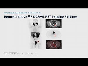 Integration of Biomarkers, MRI and PSMA PET Imaging into the Management of Prostate Cancer