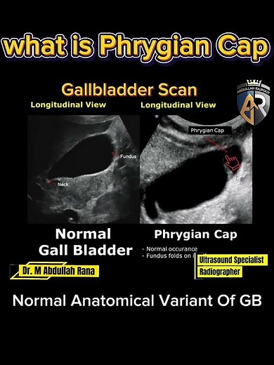what is phrygian cap in gallbladder scan❓ #radiology #ultrasound #gallbladder #medicalstudent #usg