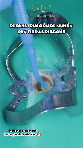 Reconstrucción de muñón con fibras RIBBOND