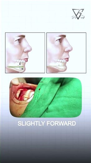 Why Your Jawline Still Looks Weak | Dr. Vikram Singh Explains